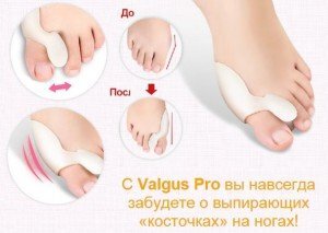 Как справиться с косточками на ногах: простые решения для дома