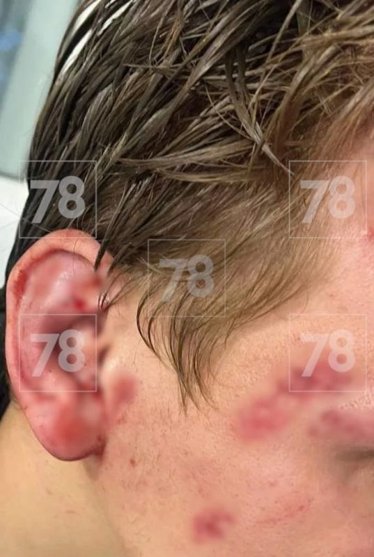 Жителя Мурино жестоко избили хулиганы из-за замечаний Жителя Мурино жестоко избили хулиганы из-за замечаний